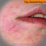 шелушение кожи вокруг губ причины
