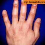 Дисплазия ногтей на руке