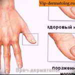 Дисплазия ногтей таблица