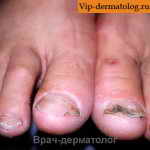Дисплазия ногтей на ногах
