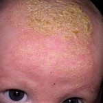 Себорея кожи головы у детей