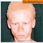 альбинизм заболевание