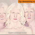 кожный альбинизм