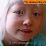 как наследуется альбинизм