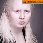 альбинизм у человека