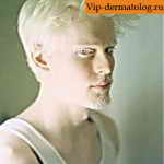 альбинизм