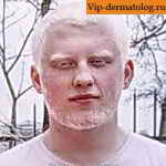 альбинизм у мужчины фото