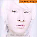 альбинизм у женщины фото