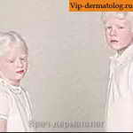 альбинизм у детей