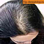 алопеция у женщин фото - выпадение волос