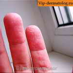 авитаминоз на пальцах рук