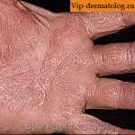 авитаминоз облазит кожа на руках