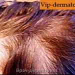 Диффузной алопеции волос