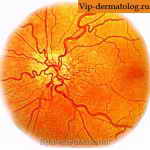 диабетическая ангиопатия фото глаза