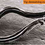 анкилостомидозные черви