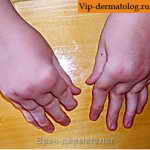 артрит пальцев рук фото