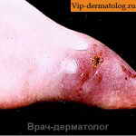 аспергиллез кожи ног