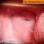 бактериальный вагиноз симптомы и фото