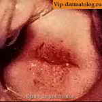 бактериальный вагиноз фото выделений