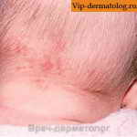 гемангиома на шее у ребенка фото