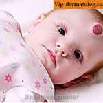 гемангиома на голове у ребенка фото