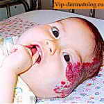 гемангиома на лице у ребенка фото