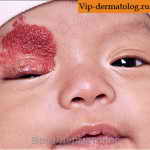 гемангиома фото новорожденных на лице