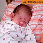 капиллярная гемангиома у новорожденных фото