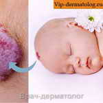 гемангиома +у новорожденных фото до и после