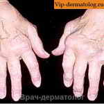 ревматоидный артрит пальцев рук фото