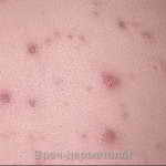 рак кожи начальная стадия фото базалиома